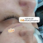 فیشال و پاکسازی تخصصی پوست سولماز