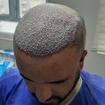 کاشت مو تبریز سونیتا