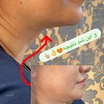 لاغری موضعی سعادت