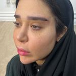کلینیک ژل بوتاکس لیزر فیل بیوتی