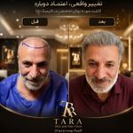 کاشت مو تارا
