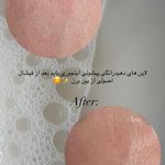 مرکز پاکسازی و پلاژن تراپی سیلکی فیشال