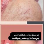 فیشیال و پاکسازی پوست مریم