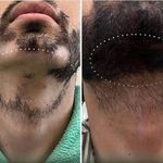 خدمات درمان جوش و لک ریزش مو کچلی مردانی