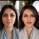 کلینیک ژل بوتاکس لیزر فیل بیوتی