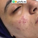 فیشال و پاکسازی تخصصی پوست سولماز