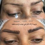 میکروبلیدینگ و فیبروز المیرا