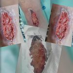 کارشناس زخم و متخصص کیوم تراپی بهرامی فر