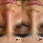 فیشال تخصصی و درمان جوش ولک Zhikan