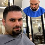 کاشت مو به روش سوپرمیکروگرفت