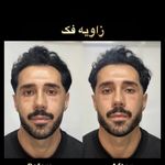 لیزر مهیاس