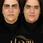 کلینیک هانیل | فیلر و بوتاکس شرق