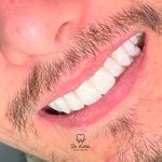 دندانپزشکی دکتر کاتبی کامپوزیت لمینیت