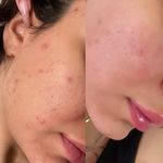 پاکسازی پوست و فیشیال طهورا (پنس بیوتی)