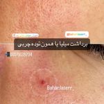 مرکز لیزر موهای زائد بهار