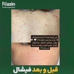 پاکسازی و فیشال صورت نازین