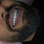 کامپوزیت ونیر