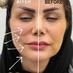 کلینیک ژل بوتاکس لیزر فیل بیوتی