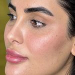 فیلر لب و مادلینک صورت