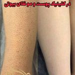 مرکز تخصصی لیزر موهای زائد فلای بیوتی