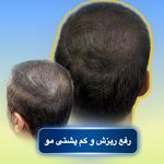 موسسه آموزش و درمان انواع ریزش مو ریشه
