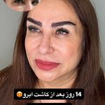 کاشت ابرو سلطانی متد پنج زاویه