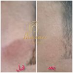 فیشال و پاکسازی پوست درنواب