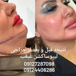 کاشت ابرو طبیعی