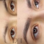 مرکز میکروبلیدینگ شیدینگ ریموو اسکالپ