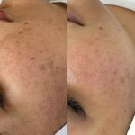 فیشال و پاکسازی پوست  آیلار شاهوردی