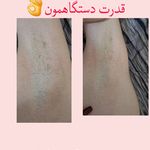 مطب لیزر موهای زائد لیورا