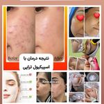 فیشال و پاکسازی پوست کارن