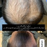 موسسه آموزش و درمان انواع ریزش مو ریشه