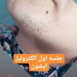 متخصص الکترولیزورفع دائمی صورت بانوان