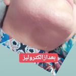 متخصص الکترولیزورفع دائمی صورت بانوان