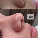 پاکسازی پوست النا