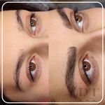 مرکز میکروبلیدینگ شیدینگ ریموو اسکالپ