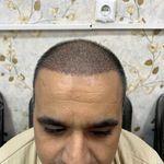 کاشت مو تخصصی سحر تلوری