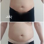 کلینیک تخصصی لاغری موضعی ولافیت