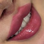 خانه لیزر فیلر و بوتاکس ثنا