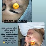 پاکسازی پوست به صورت حرفه ای و تخصصی – خانم سارا حزباویان