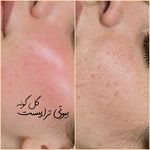 پاکسازی پوست اراک