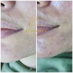 فیشال و پاکسازی پوست درنواب