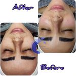 فیشال تخصصی و درمان جوش ولک Zhikan