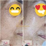 فیشال و پاکسازی پوست درنواب