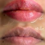 میکروبلیدینگ شیدینگ لب ساری و جویبار