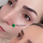 میکروبلیدینگ،میکروپیگمشنتیشن هاجر