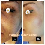 مرکز لیزر الماس