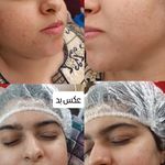 پاکسازی انواع پوست ها درمنزل