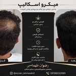 مرکز میکروبلیدینگ شیدینگ ریموو اسکالپ